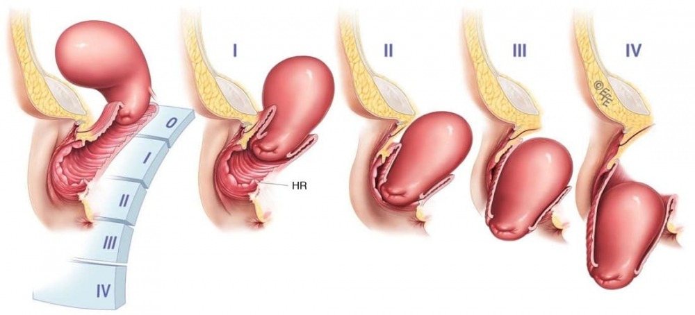 Опущение органов малого таза у женщин: показания к операции