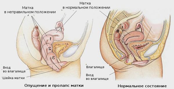 Лечение опущенной матки у хорошего врача гинеколога в частных клиниках Хабаровска