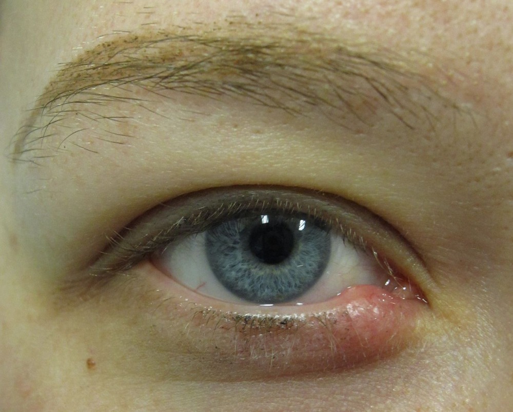 Причины появления глазного ячменя
